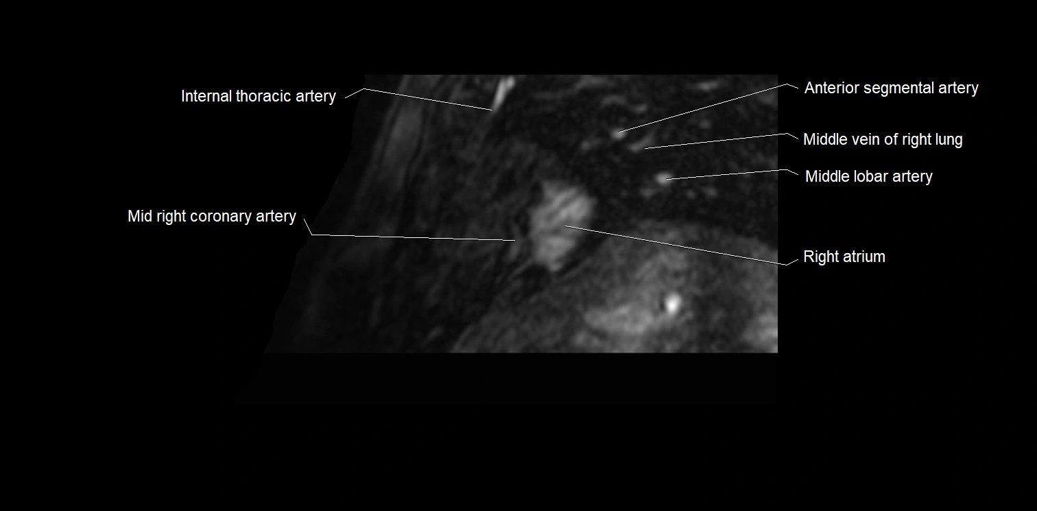MRI heart and coronary arteries two chamber(sagittal)  anatomy image 1.webp